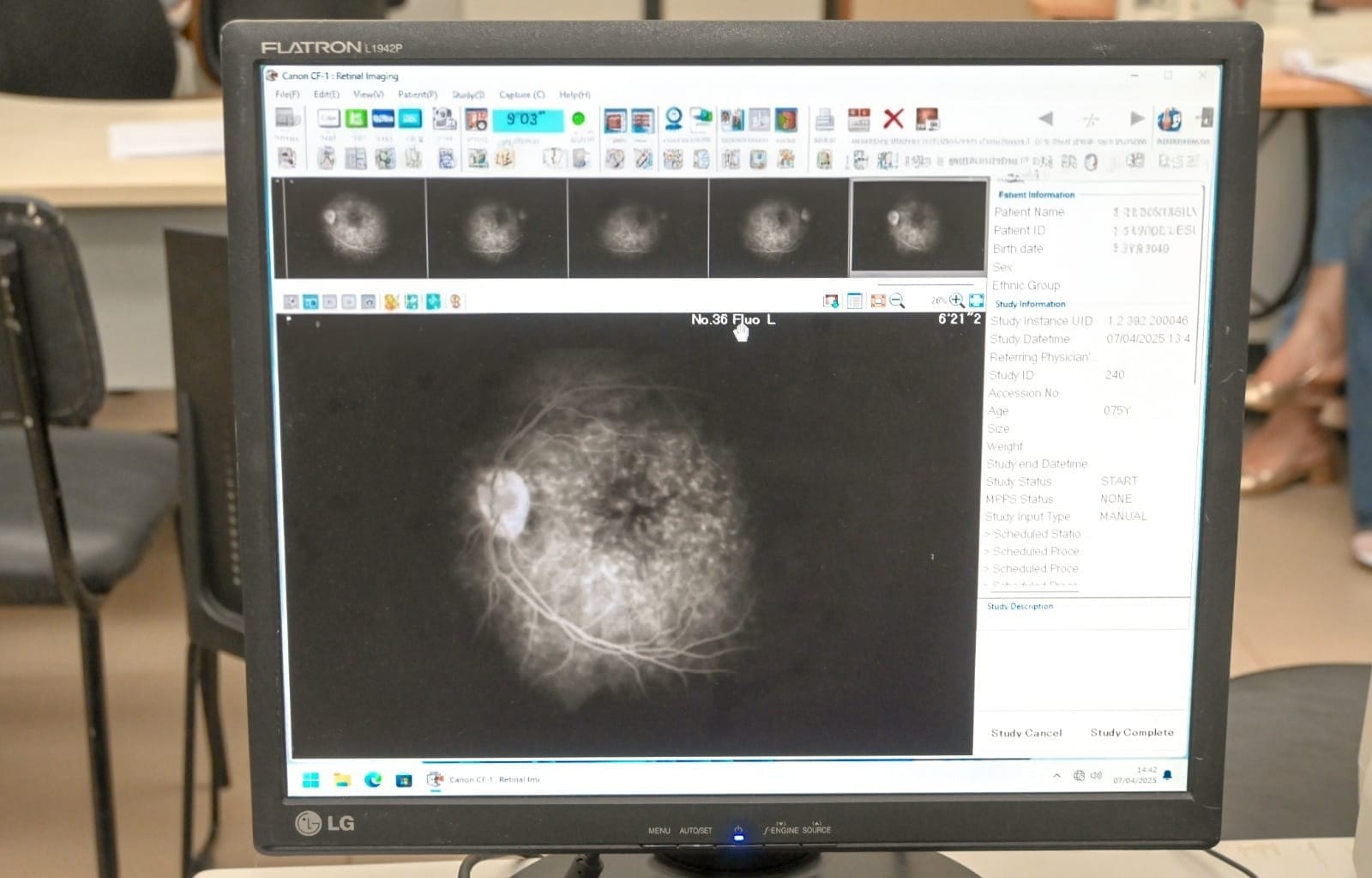 Glaucoma evolui sem sintomas e já é a principal causa de cegueira irreversível no mundo