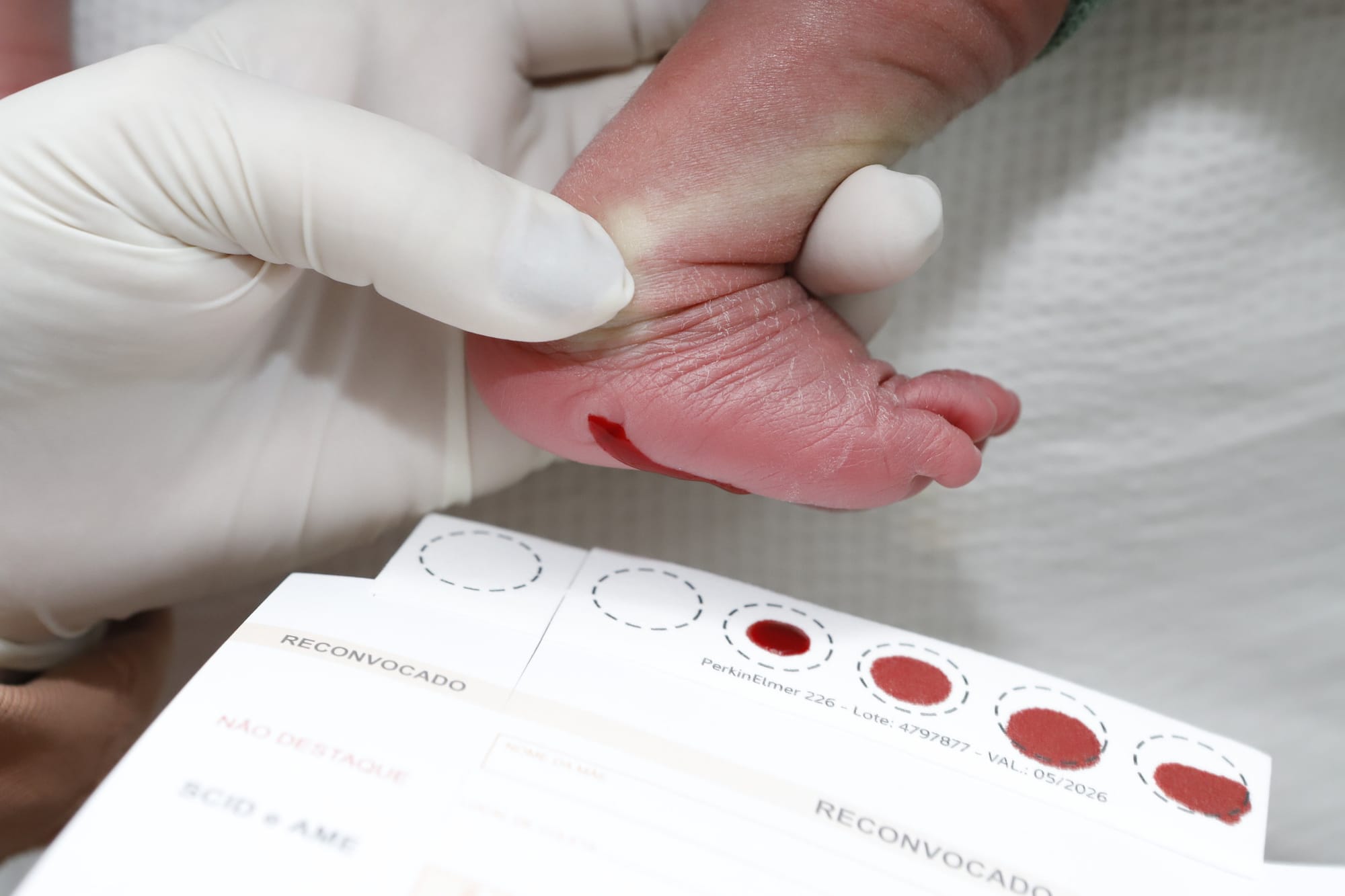 DF é pioneiro no diagnóstico precoce da doença de Fabry pelo teste do pezinho