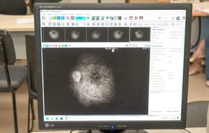 Glaucoma evolui sem sintomas e já é a principal causa de cegueira irreversível no mundo